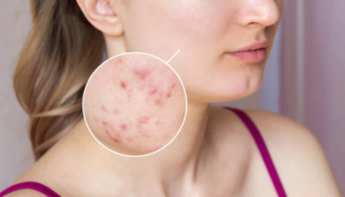 How Often Should You Exfoliate? Signs You’re Overdoing Scrubs and Peels