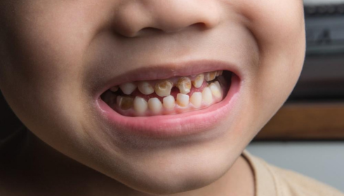 Why Treating Cavities in Milk Teeth Matters Even Though They Fall Out