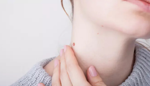 Wart Removal Options: Home Remedies vs Clinical Treatments Explained
