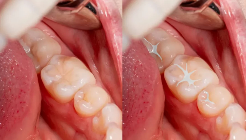 Dental Sealants for Kids: How Protective Coatings Help Prevent Future Cavities
