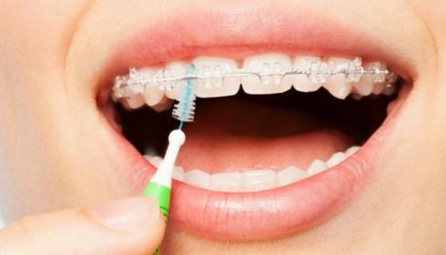 Interdental Brushes vs Floss for Braces: Best Way to Clean Around Wires